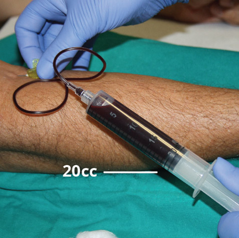 pro-prp-kit-fase2 Prelievo sangue venoso