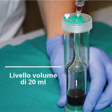 pro-prp-kit-fase3 Spostare il sengue prelevato nel separatore PRO PRP