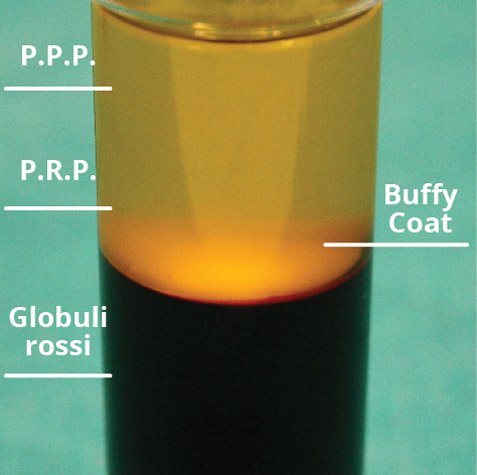 pro-prp-kit-fase5 Risultato dopo la centrifuga