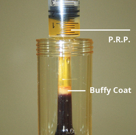 pro-prp-kit-fase7 Estrazione del concentrato piastrinico PRP
