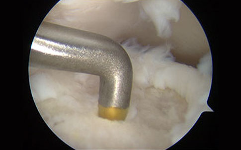 Arthroscopic view of the chondral pick used to perform microfractures