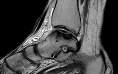 Sagittal ankle MRI of a patient included in the study