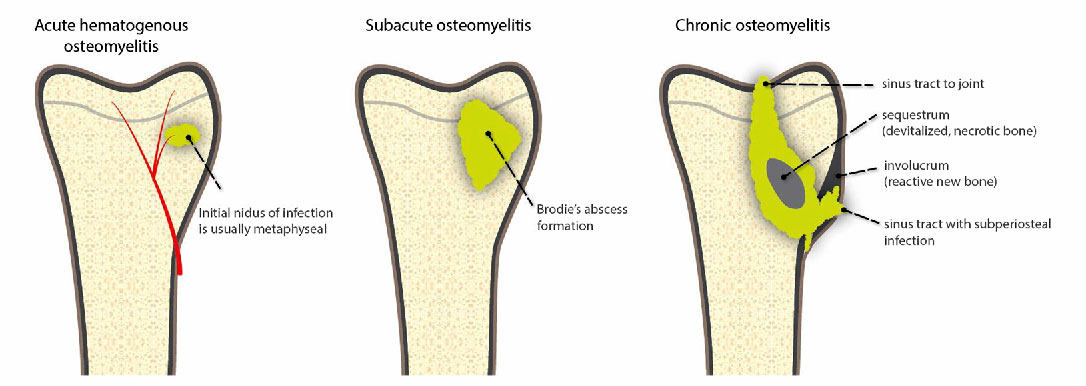 Le tre tipologie di osteomielite