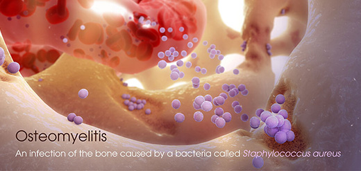 Germi e osteomielite