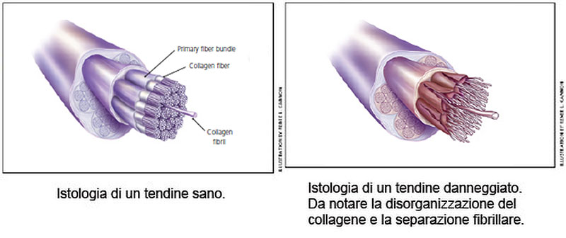 Degenerazione tendinea Degenerazione tendinea